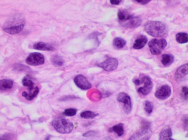 Akute Sinusitis